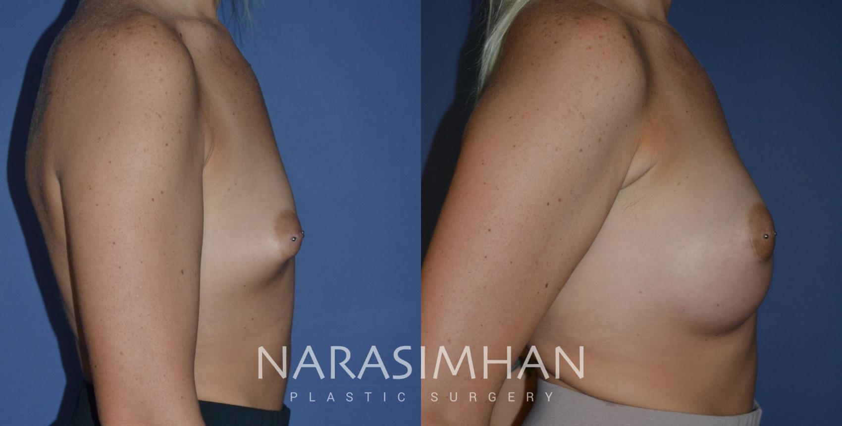 Before & After Breast Augmentation Case 242 View #1 View in Tampa, Florida