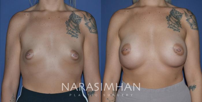 Before & After Breast Augmentation Case 242 View #2 View in Tampa, Florida