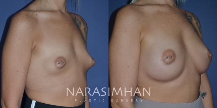 Before & After Breast Augmentation Case 242 View #3 View in Tampa, Florida