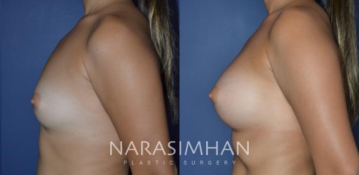 Before & After Breast Augmentation Case 269 View #3 View in St Petersburg, Florida