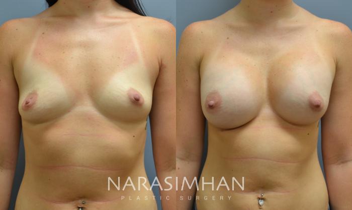 Before & After Breast Augmentation Case 28 View #1 View in St Petersburg, Florida