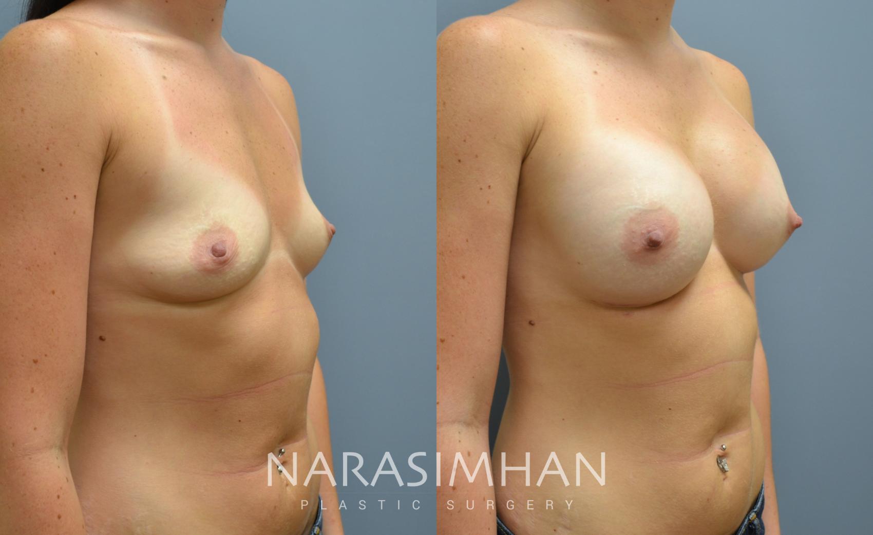 Before & After Breast Augmentation Case 28 View #2 View in St Petersburg, Florida