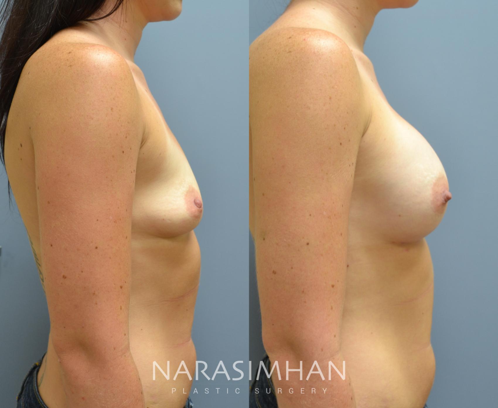 Before & After Breast Augmentation Case 28 View #3 View in St. Petersburg, Florida