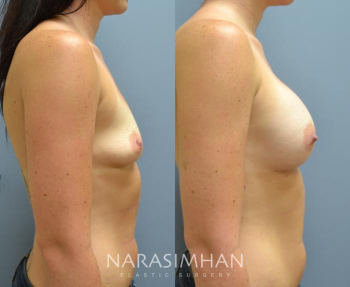Before & After Breast Augmentation Case 28 View #3 View in St Petersburg, Florida