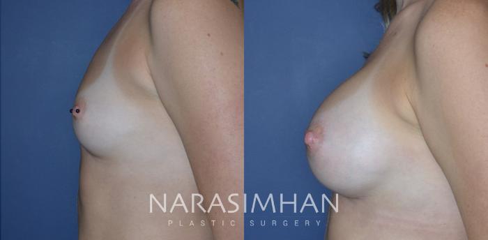 Before & After Breast Augmentation Case 286 Left Side View in Tampa, Florida