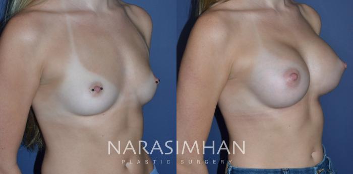 Before & After Breast Augmentation Case 286 Right Oblique View in Tampa, Florida
