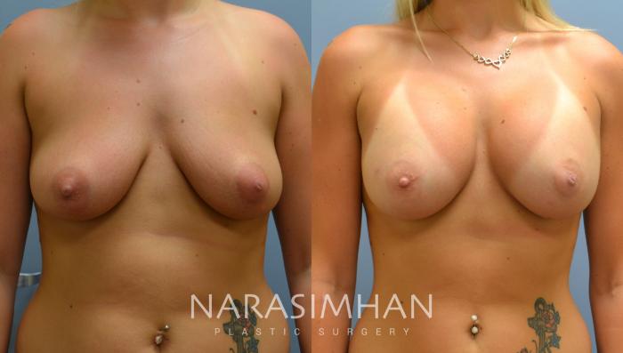 Before & After Breast Augmentation Case 29 View #1 View in St Petersburg, Florida