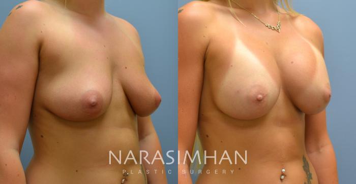 Before & After Breast Augmentation Case 29 View #2 View in Tampa, Florida