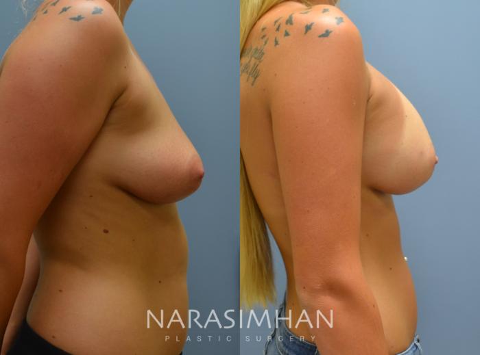 Before & After Breast Augmentation Case 29 View #3 View in Tampa, Florida