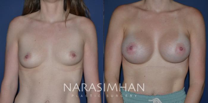 Before & After Breast Augmentation Case 295 Front View in Tampa, Florida