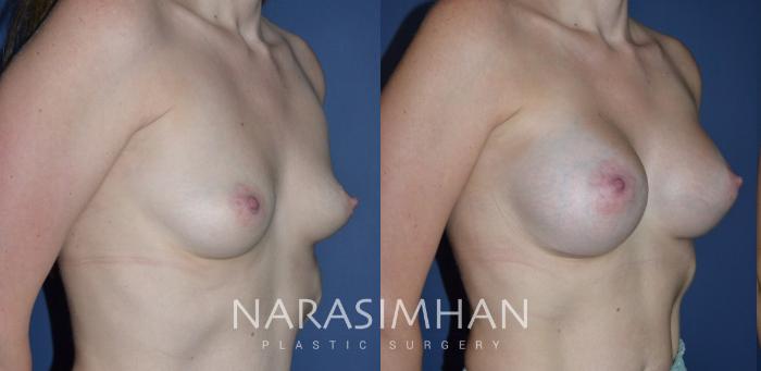 Before & After Breast Augmentation Case 295 Right Oblique View in Tampa, Florida