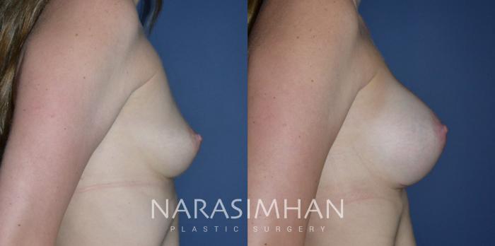 Before & After Breast Augmentation Case 295 Right Side View in Tampa, Florida