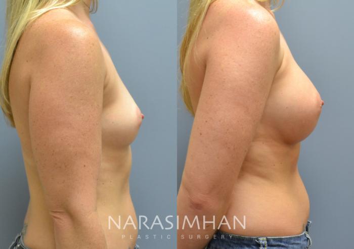 Before & After Breast Augmentation Case 30 View #2 View in Tampa, Florida