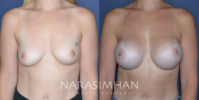 Before & After Breast Augmentation Case 309 Front View in Tampa, Florida