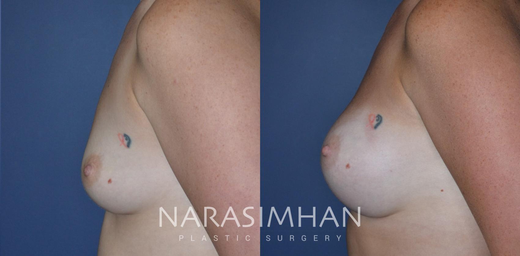 Before & After Breast Augmentation Case 309 Left Side View in Tampa, Florida