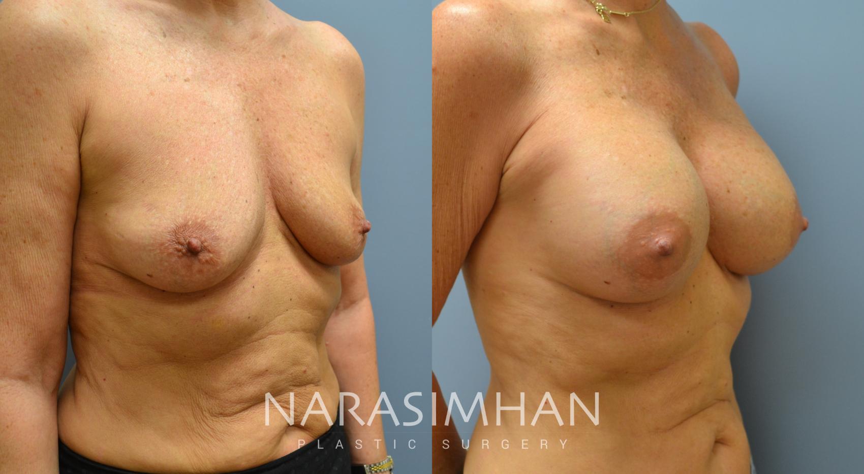 Before & After Breast Augmentation Case 31 View #1 View in Tampa, Florida