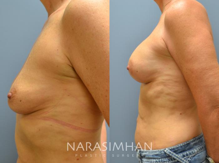 Before & After Breast Augmentation Case 31 View #2 View in St Petersburg, Florida
