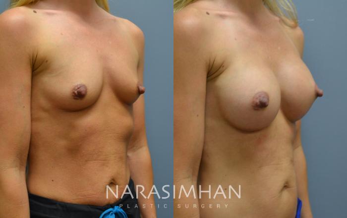 Before & After Breast Augmentation Case 32 View #2 View in Tampa, Florida