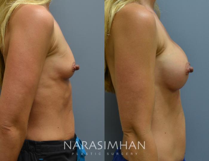 Before & After Breast Augmentation Case 32 View #3 View in Tampa, Florida