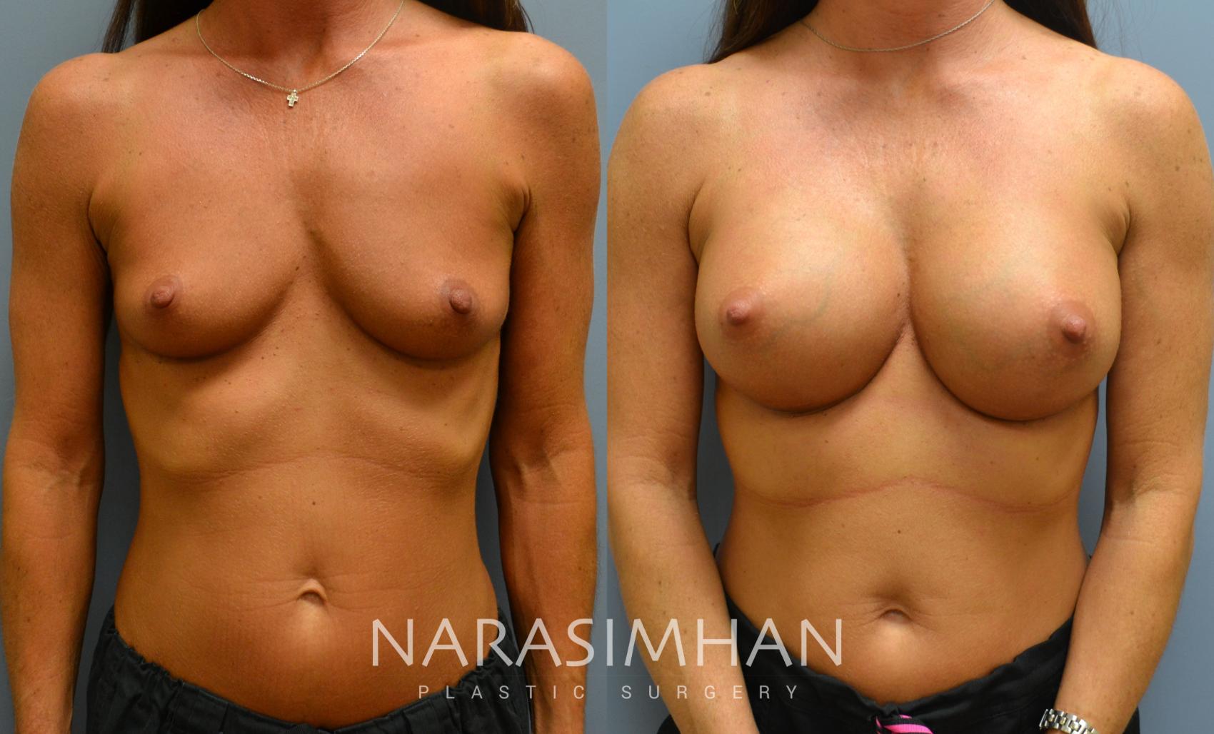 Before & After Breast Augmentation Case 55 View #1 View in St. Petersburg, Florida