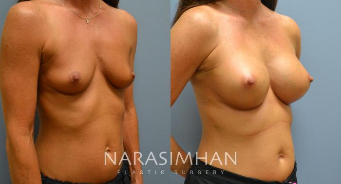 Before & After Breast Augmentation Case 55 View #2 View in Tampa, Florida