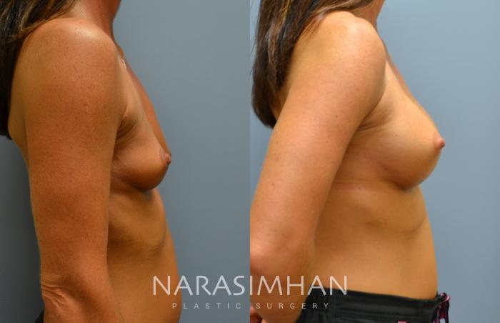 Before & After Breast Augmentation Case 55 View #3 View in Tampa, Florida
