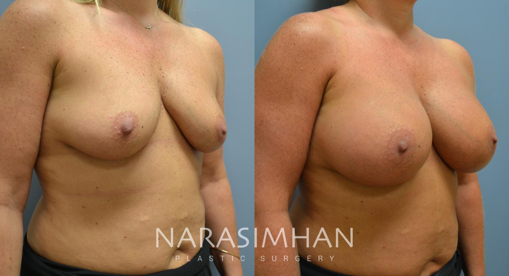 Before & After Breast Augmentation Case 58 View #1 View in Tampa, Florida