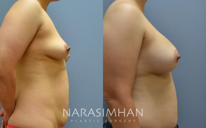 Before & After Breast Augmentation Case 60 View #3 View in Tampa, Florida