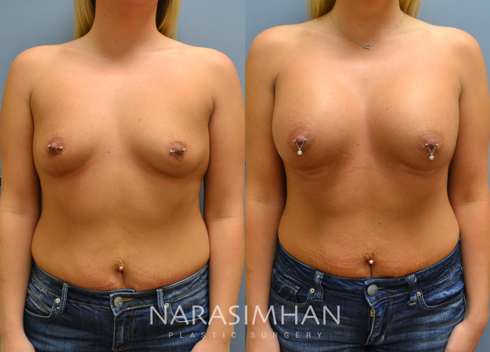 Before & After Breast Augmentation Case 7 View #1 View in St Petersburg, Florida