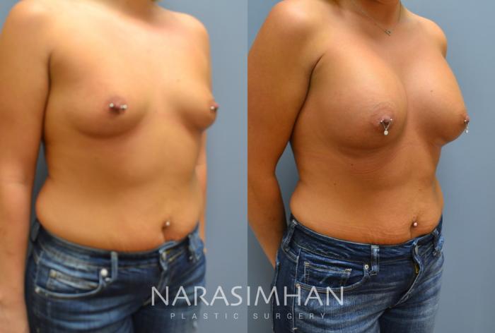 Before & After Breast Augmentation Case 7 View #2 View in St Petersburg, Florida