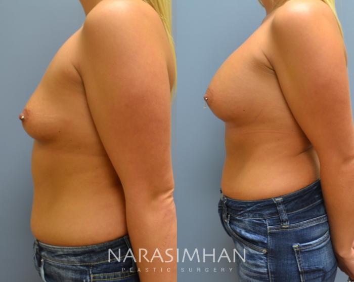 Before & After Breast Augmentation Case 7 View #3 View in St Petersburg, Florida