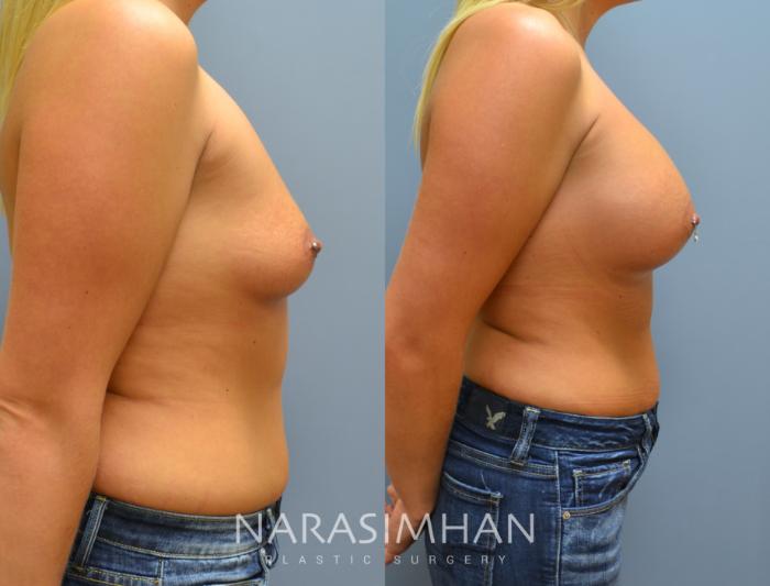 Before & After Breast Augmentation Case 7 View #4 View in St Petersburg, Florida