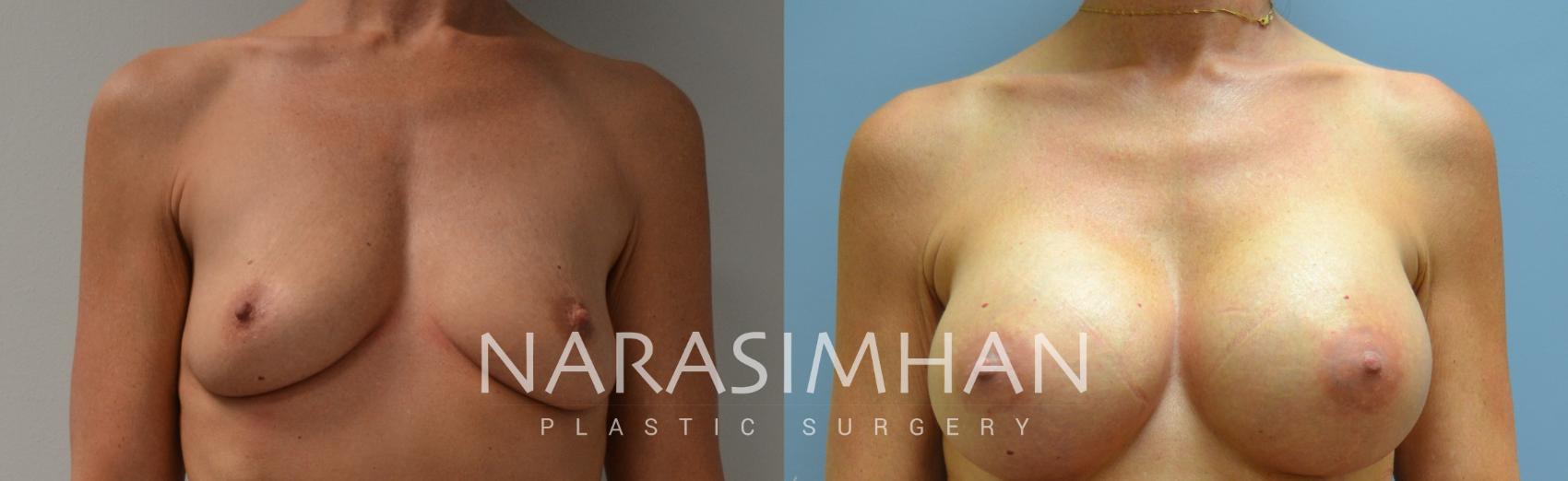 Before & After Breast Augmentation Case 85 View #1 View in St. Petersburg, Florida