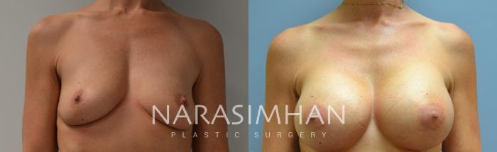 Before & After Breast Augmentation Case 85 View #1 View in Tampa, Florida