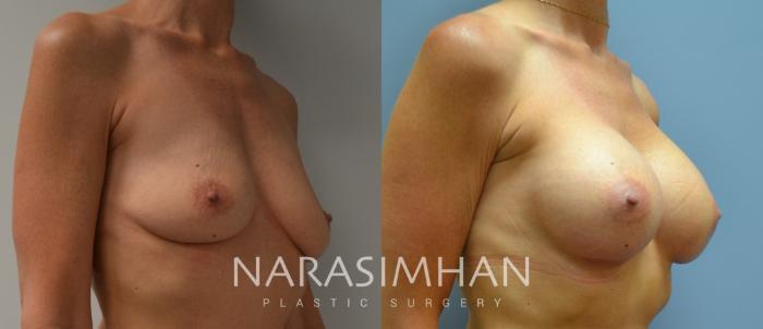 Before & After Breast Augmentation Case 85 View #2 View in Tampa, Florida