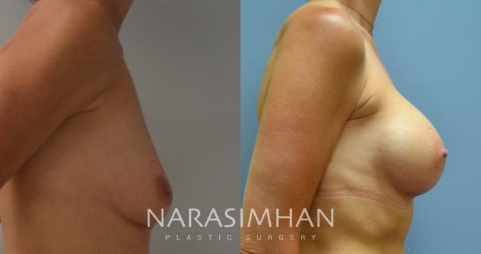Before & After Breast Augmentation Case 85 View #3 View in Tampa, Florida