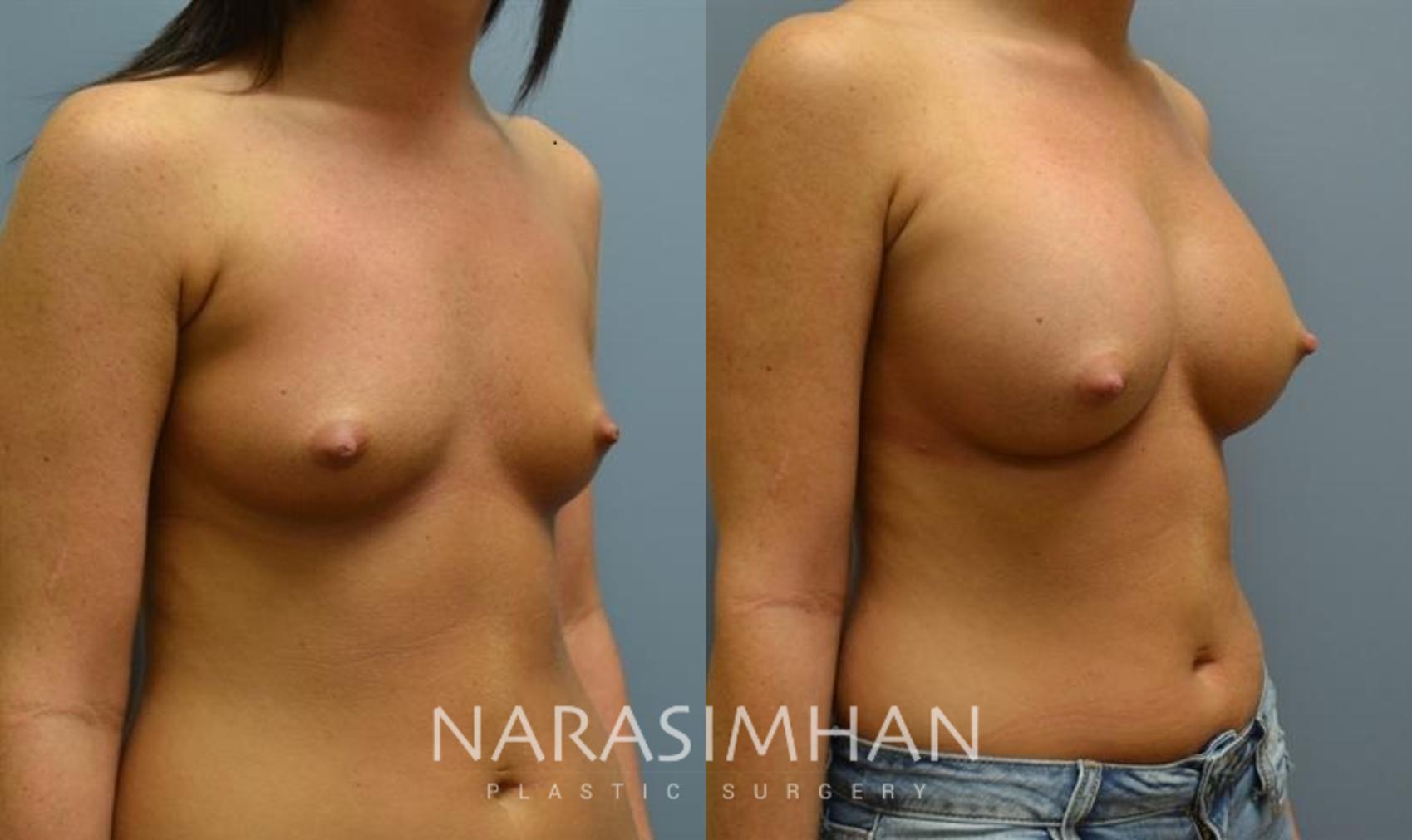 Before & After Breast Augmentation Case 88 View #1 View in St. Petersburg, Florida