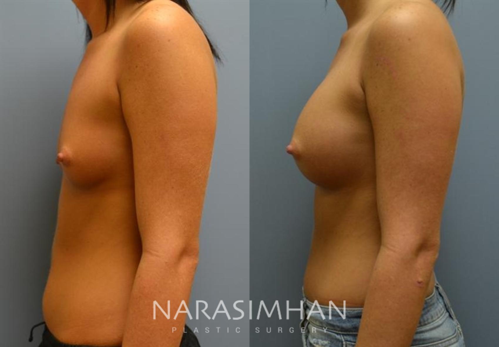 Before & After Breast Augmentation Case 88 View #2 View in St. Petersburg, Florida