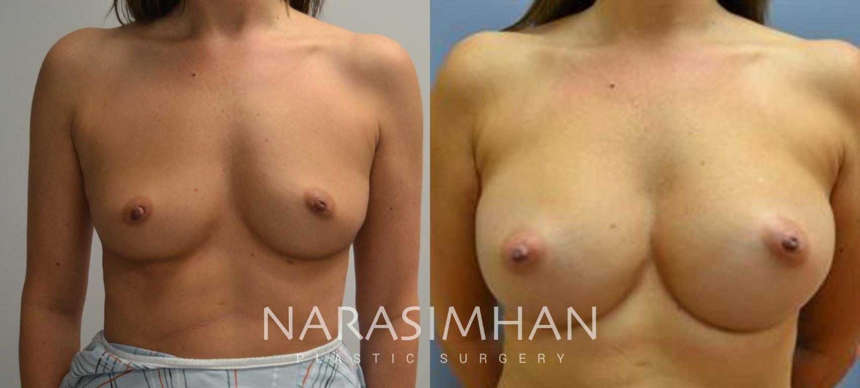 Before & After Breast Augmentation Case 89 View #1 View in Tampa, Florida