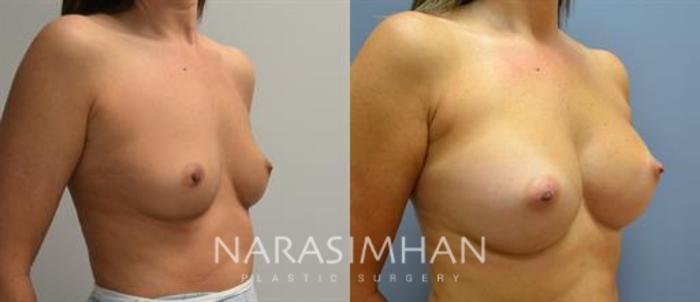 Before & After Breast Augmentation Case 89 View #2 View in Tampa, Florida