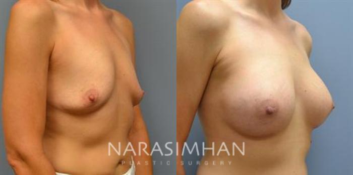 Before & After Breast Augmentation Case 91 View #1 View in Tampa, Florida