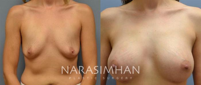 Before & After Breast Augmentation Case 91 View #2 View in Tampa, Florida