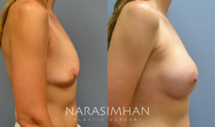 Before & After Breast Augmentation Case 91 View #3 View in Tampa, Florida