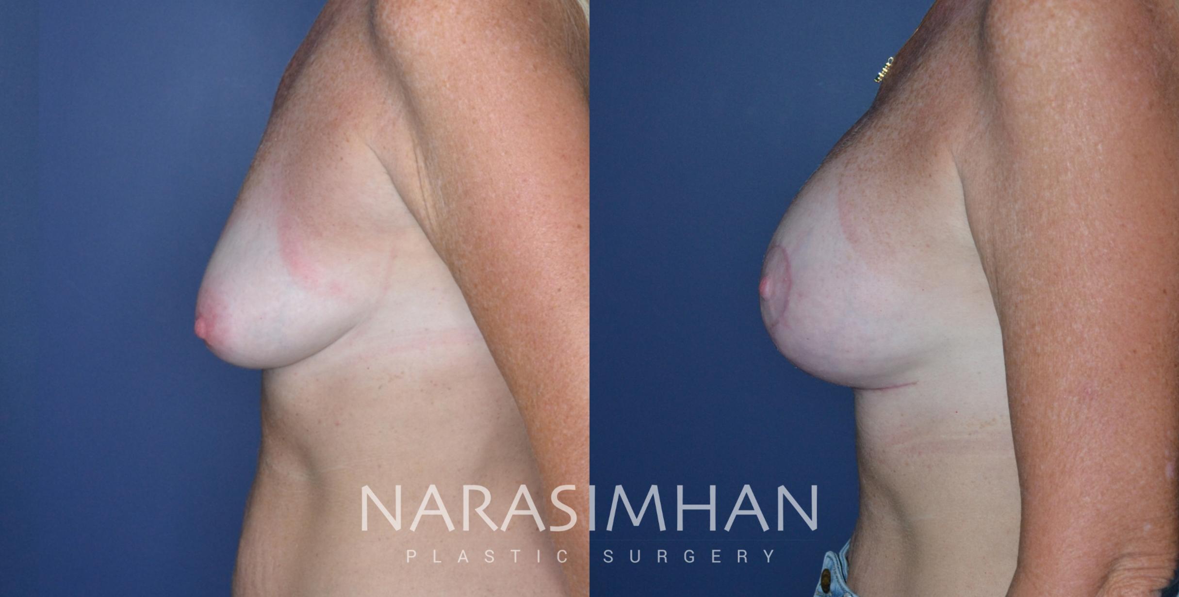 Before & After Mastopexy Case 239 View #1 View in St Petersburg, Florida