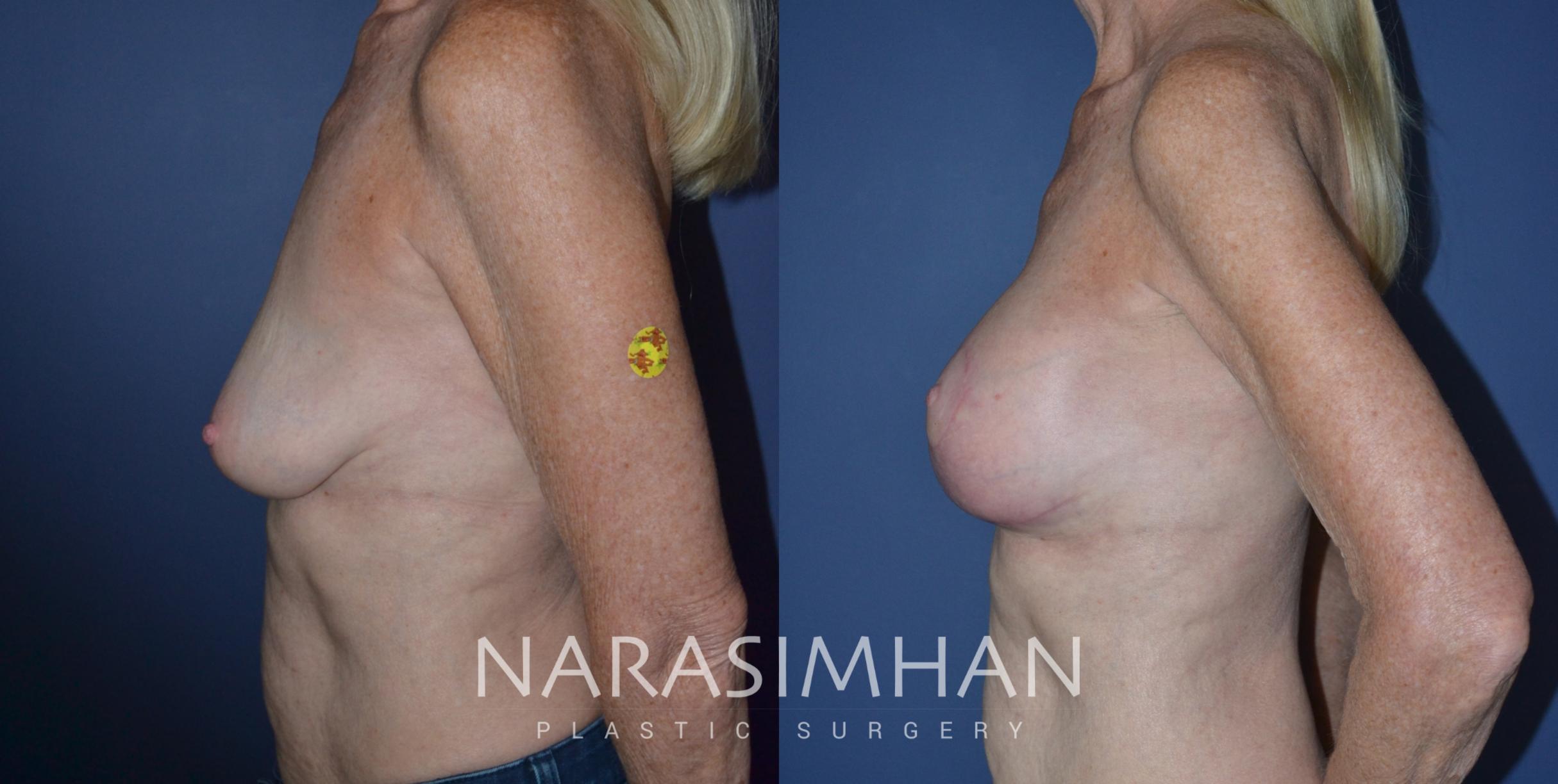 Before & After Breast Augmentation with Lift (Mastopexy) Case 244 View #1 View in St Petersburg, Florida