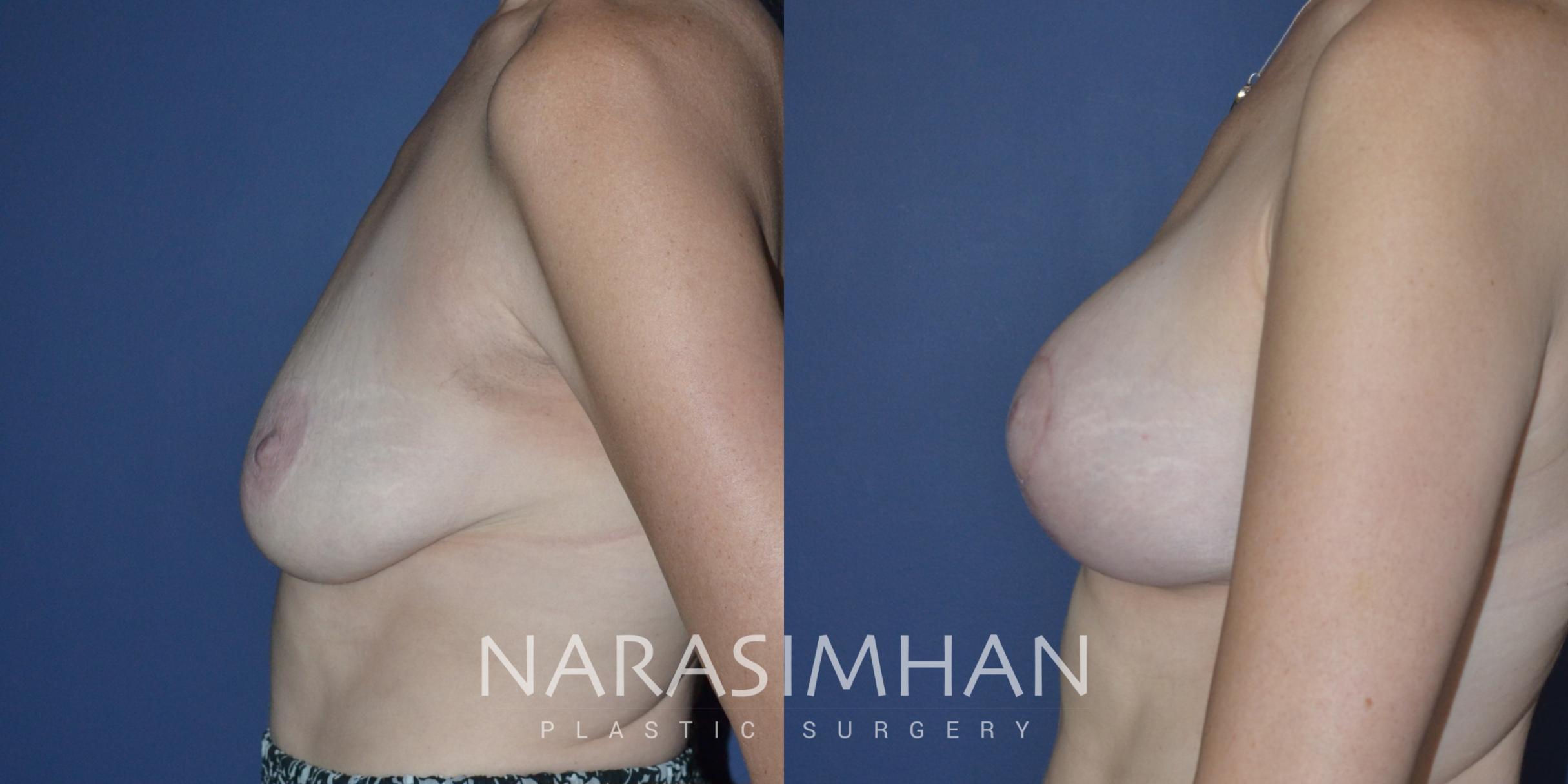 Before & After Mastopexy Case 274 View #1 View in St Petersburg, Florida