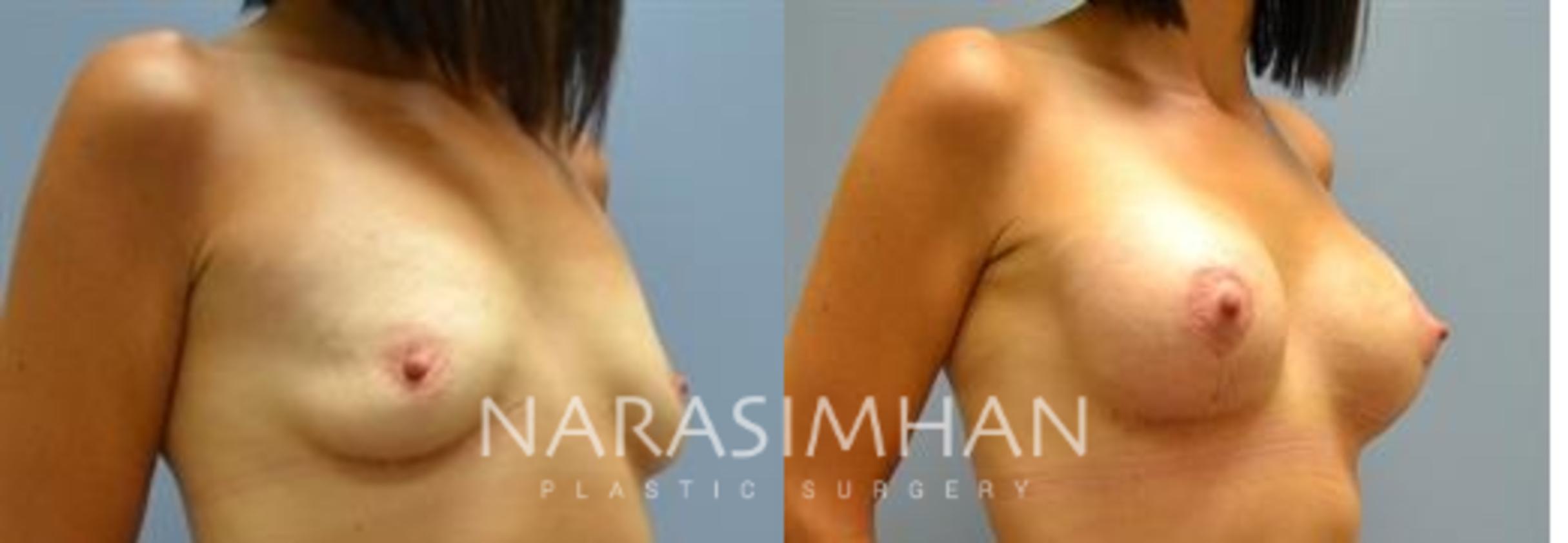 Before & After Mastopexy Case 33 View #1 View in St Petersburg, Florida