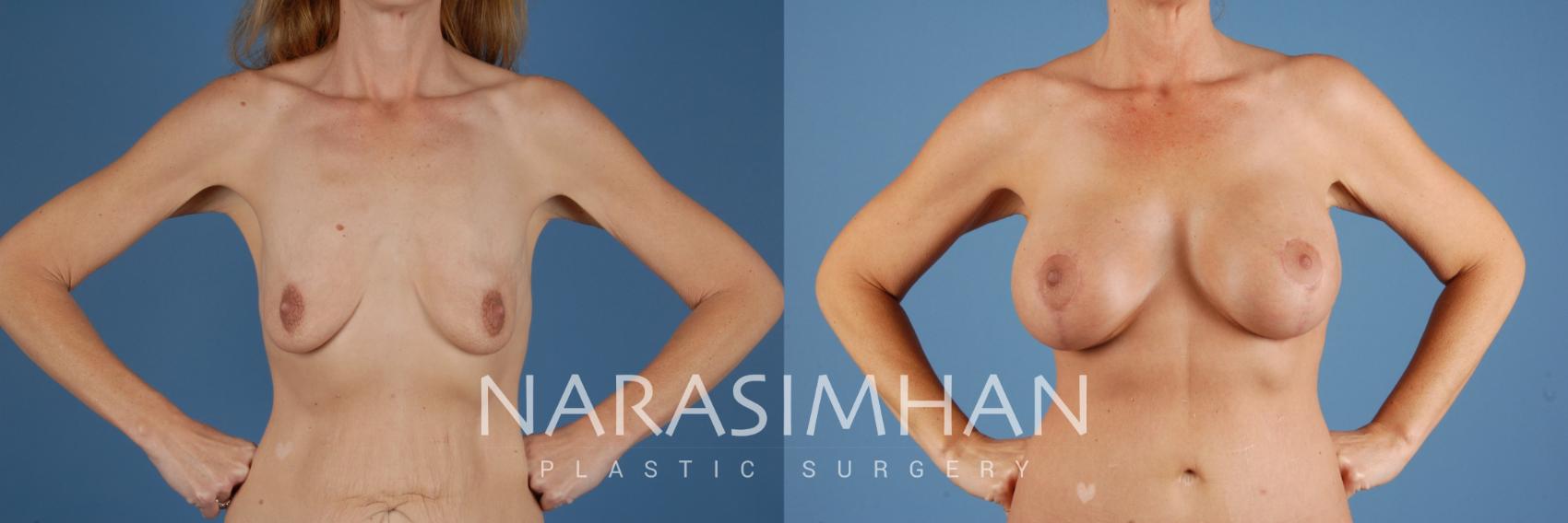 Before & After Breast Augmentation with Lift (Mastopexy) Case 105 View #1 View in St Petersburg, Florida