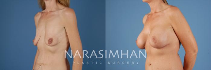 Before & After Breast Augmentation with Lift (Mastopexy) Case 105 View #2 View in St Petersburg, Florida