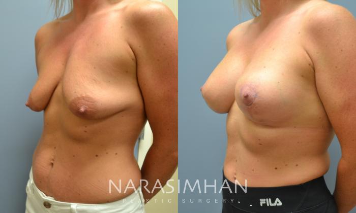 Before & After Breast Augmentation with Lift (Mastopexy) Case 12 View #2 View in St Petersburg, Florida